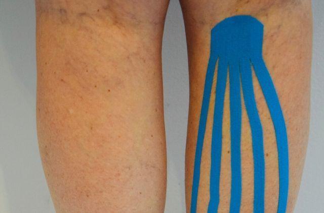 Kinesitherapie Re-flex - Foto van de achterkant van een knie die ingetapet is Foto van de achterkant van een knie die ingetapet is